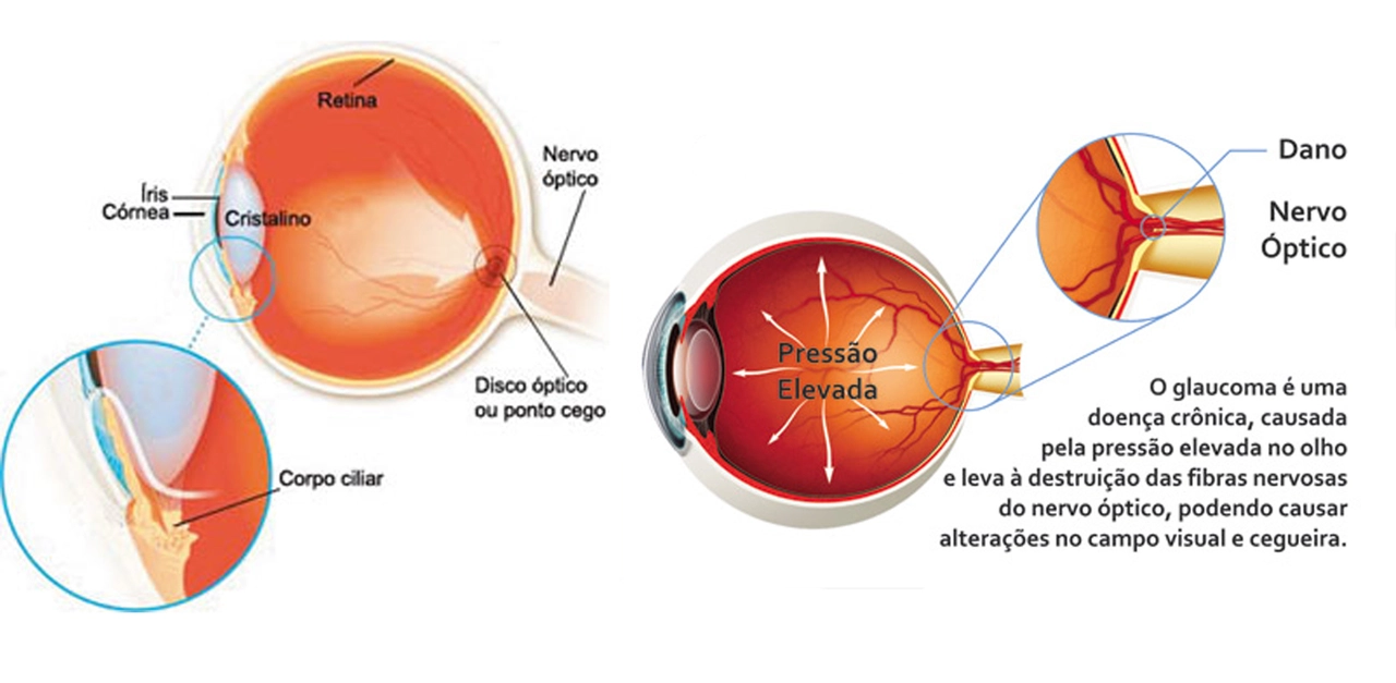 El papel de la investigación en el avance de las opciones de tratamiento para el glaucoma de ángulo abierto